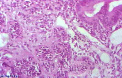 Duodenal Carcinoid (4 of 4)