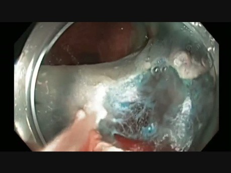Colonoscopy - Rectum - Large Polyp - EMR