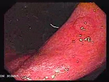 Gastric Polyp (1 of 7)