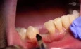 Failed Implant Bridge Gets Replaced