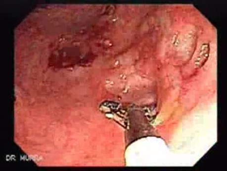Multiple Rectal Ulcers (7 of 110)