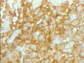 Lymphoma B small cells of the Jejuno (10 of 10)