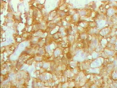 Lymphoma B small cells of the Jejuno (10 of 10)