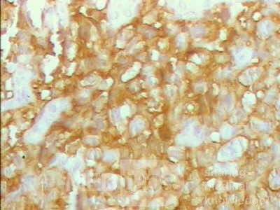 Lymphoma B small cells of the Jejuno (10 of 10)