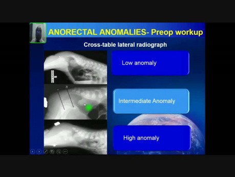 Anorectal Anomalies