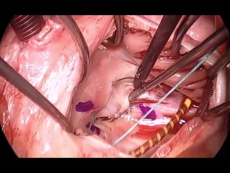 Tricuspid Valve Repair in Patient with PPM 