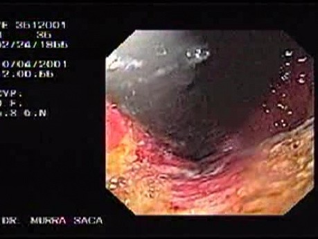 Hereditary Diffuse Gastric Cancer (HDGC) - Endoscopy (3 of 4)