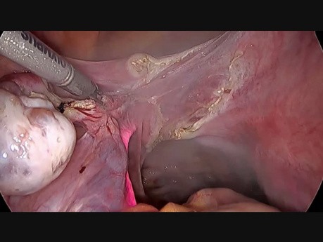 TLH with Ureter Stenting