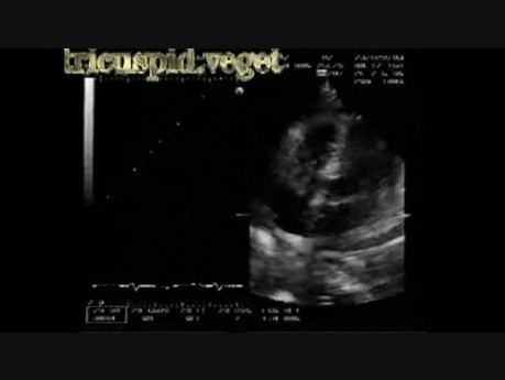 Infective Endocarditis: Large Vegetation On The Tricuspid Valve