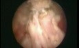 Transurethral Resection of the Prostate - TURP 