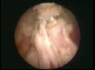 Transurethral Resection of the Prostate - TURP 