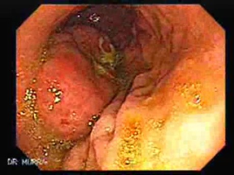 Gastrointestinal Stromal Tumor - GIST (2 of 13)