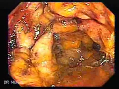 Toxic Dilatation Of The Colon Superimposed Pseudomembranous Colitis (6 z 17)