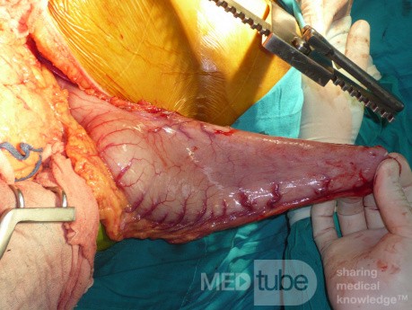 Adenocarcinoma of the cardias and gastric fundus with signet-ring cells (6 of 25)