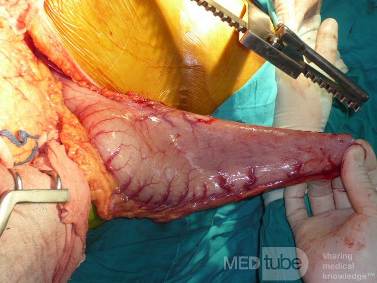 Adenocarcinoma of the cardias and gastric fundus with signet-ring cells (6 of 25)