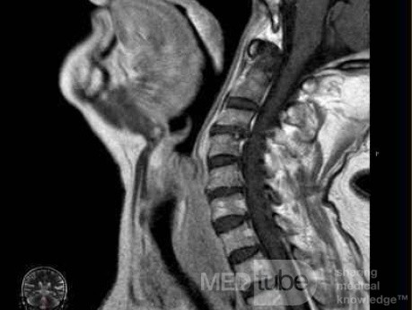 Esophageal Squamous Cell Carcinoma of the the upper third of the Esophagus that invades the subglotic (6 of 8)