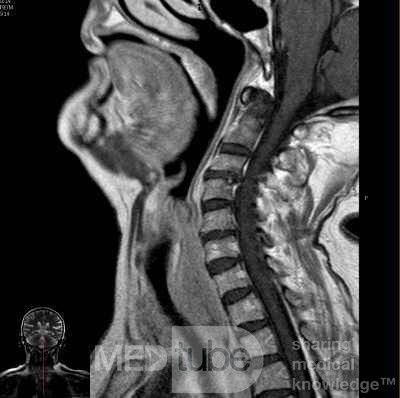 Esophageal Squamous Cell Carcinoma of the the upper third of the Esophagus that invades the subglotic (6 of 8)