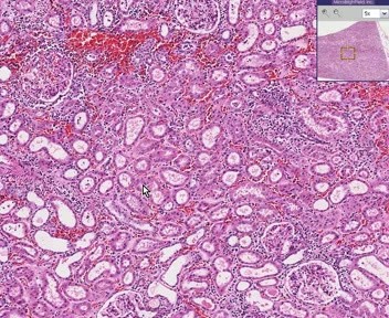 Interstitial Nephritis