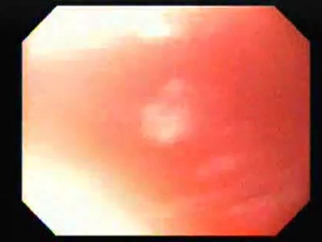 Achalasia - residual food (7 of 11)