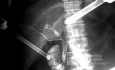 Gallbladder Opaque Stones & Cystic Duct Variation in IOC