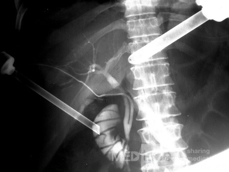 Gallbladder Opaque Stones & Cystic Duct Variation in IOC