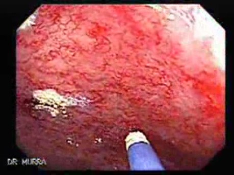 Post-Radiation Colitis (4 of 13)