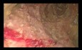EUS-Guided Necrosectomy