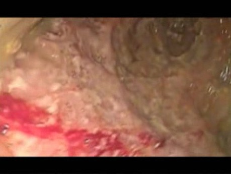 EUS-Guided Necrosectomy