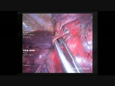 Uniportal VATS Anatomic Right Upper Lobe Posterior Segmentectomy (S2)