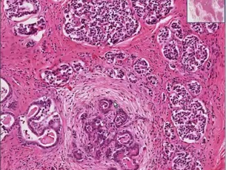 Cystic fibrosis