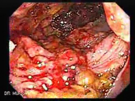 Toxic Dilatation Of The Colon Superimposed Pseudomembranous Colitis (11 z 17)