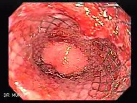 Placement Of The Esophageal Stent - 12/12