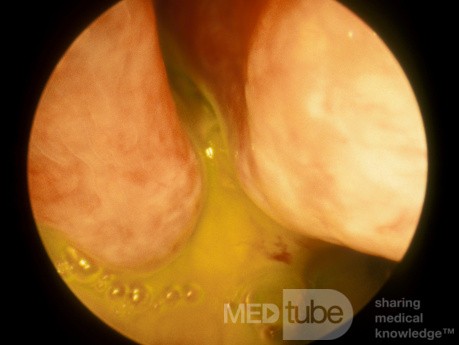 The Fluorescein Test For CSF Rhinorrhea