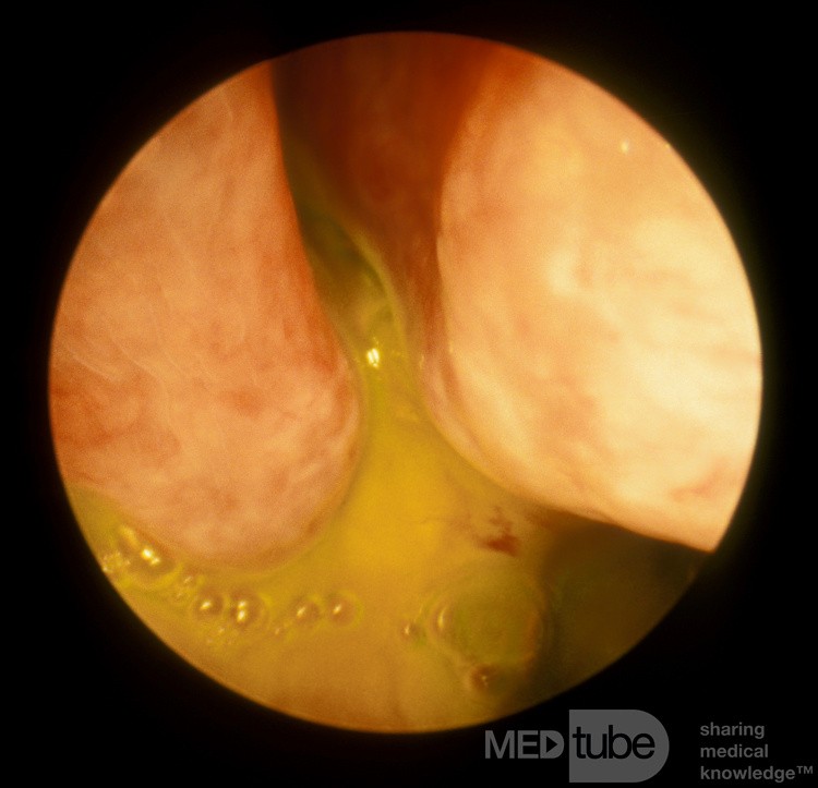 The Fluorescein Test For CSF Rhinorrhea