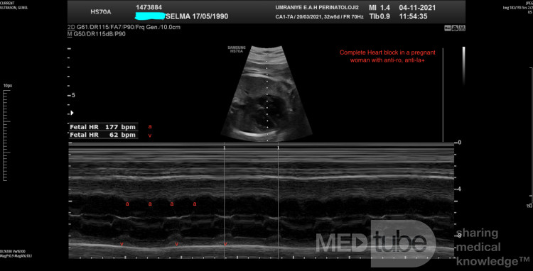 Complete AV Block in a Pregnant Woman with Anti-ro, Anti-la +