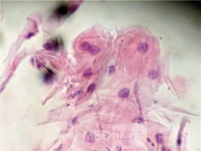 Esophageal Candidiasis Infected with Bacteria (5 of 6)