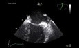 Transesophageal Echocardiography a Quiz (Abnormal Finding)  and a Review of Some Basic Views