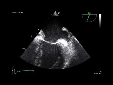 Transesophageal Echocardiography a Quiz (Abnormal Finding)  and a Review of Some Basic Views