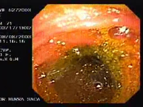 Esophago-Jejunostomy Roux-en-Y (3 of 6)