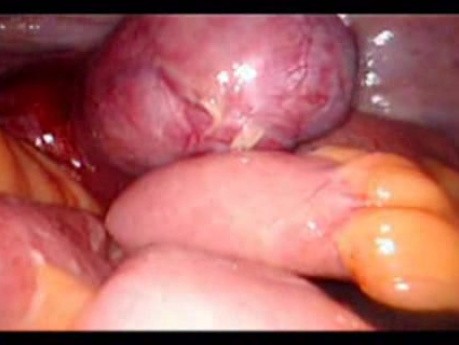 Colonic Perforation With Peritonitis - Laparoscopy (26 of 46)