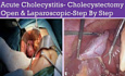 Acute Cholecystitis and Cholecystectomy - Open & Laparoscopic