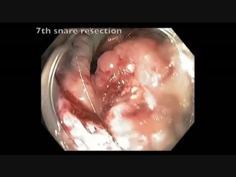 EMR Of A Giant Sessile Polyp In Ascending Colon