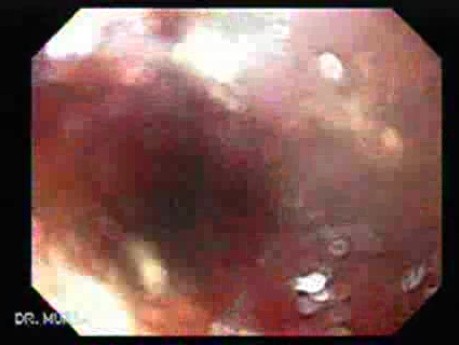 Adenocarcinoma of the Gastroesophageal Junction - Transendoscopic Ablation