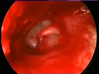 Stapedectomy