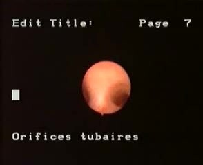 Hysteroscopic Aspect Of Septate Uterus