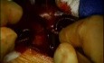 Minimally Invasive Left Atrial Myxoma Resection with "Invisible" Scar 