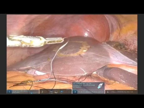 Robotic Subsegmental Parenchymal Sparing Resection for Metastatic Colorectal Carcinoma