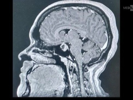 Transseptal Approach for Resection of Pit Adenoma Approved with CT