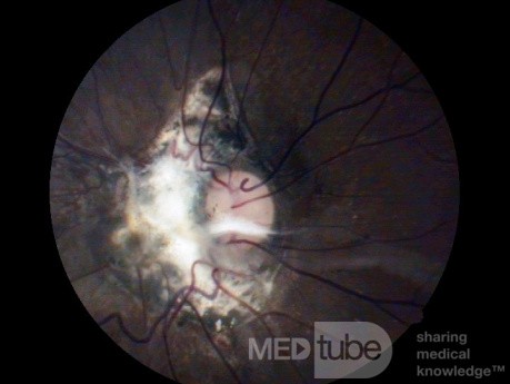 Traumatic Optic Nerve Avulsion