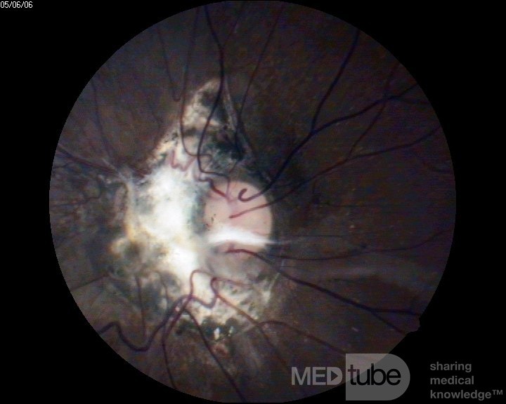 Traumatic Optic Nerve Avulsion